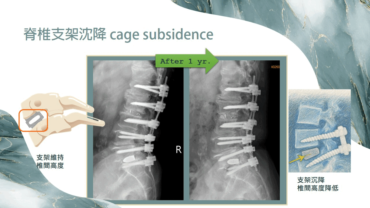 支架沉降示意圖