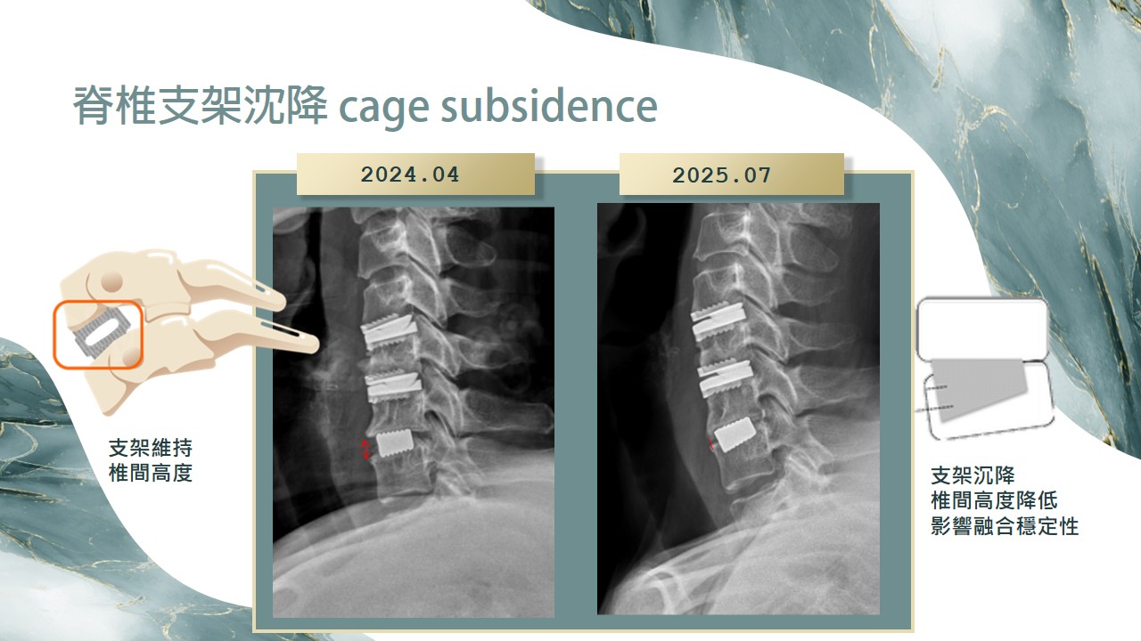 支架沉降示意圖