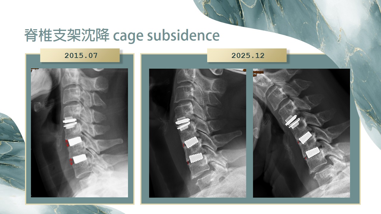 支架沉降示意圖