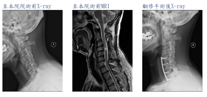 頸椎翻修手術案例影像