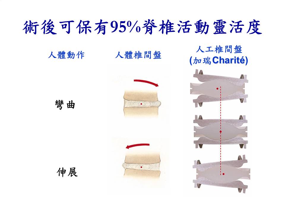 人工椎間盤特點2