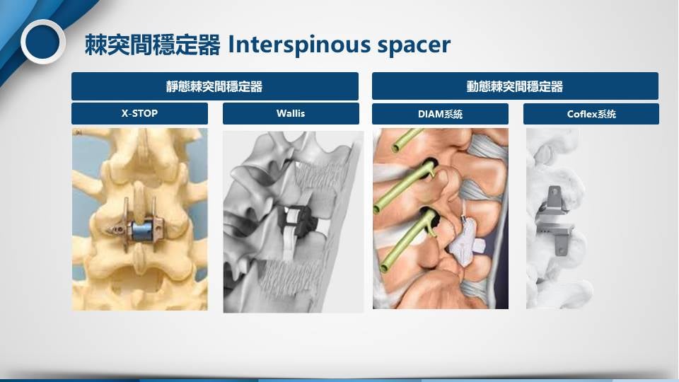 Interspinous spacer 脊突間穩定器示意圖