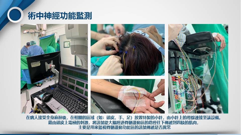 術中神經功能監測影像