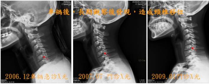 頸椎外傷個案示意圖