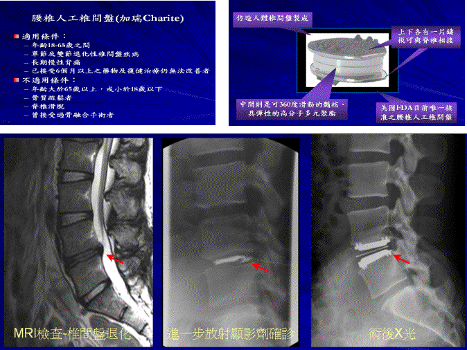 腰椎人工椎間盤示意圖