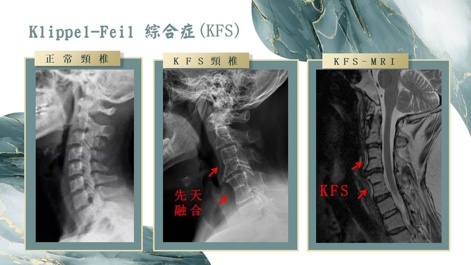 Klippel-Feil 綜合症示意圖