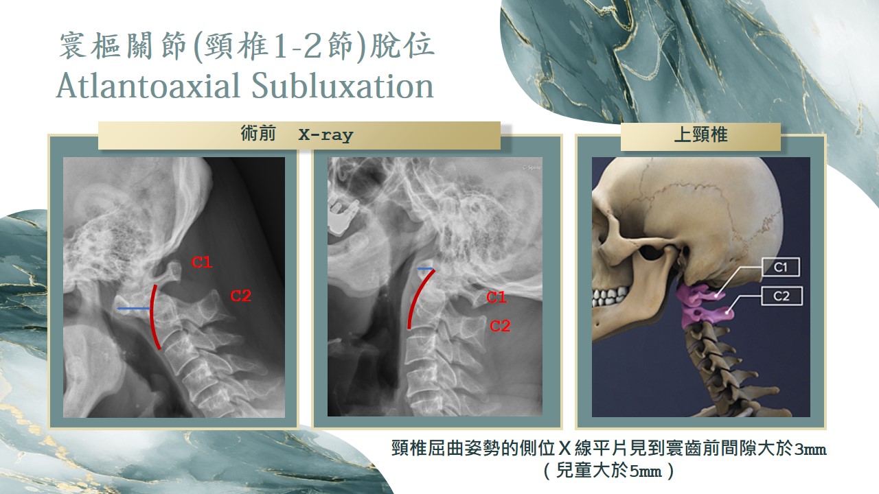 上頸椎示意圖