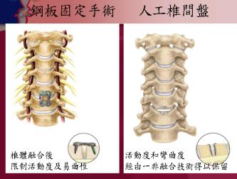 人工椎間盤示意圖 B