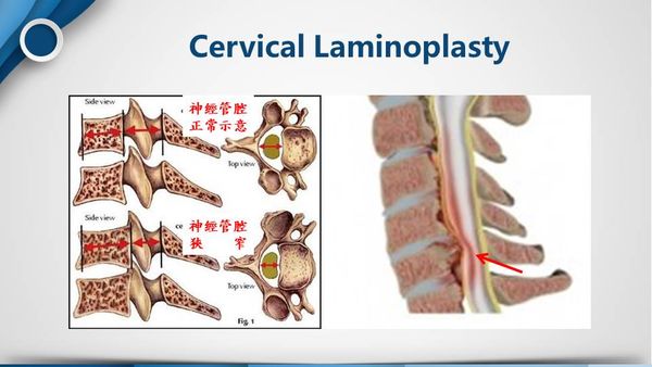 Laminoplasty 示意圖 A