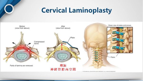 Laminoplasty 示意圖 B