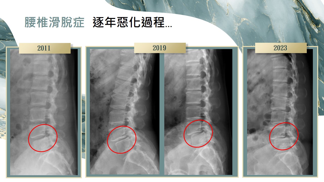 脊椎滑脫影像 投影片104
