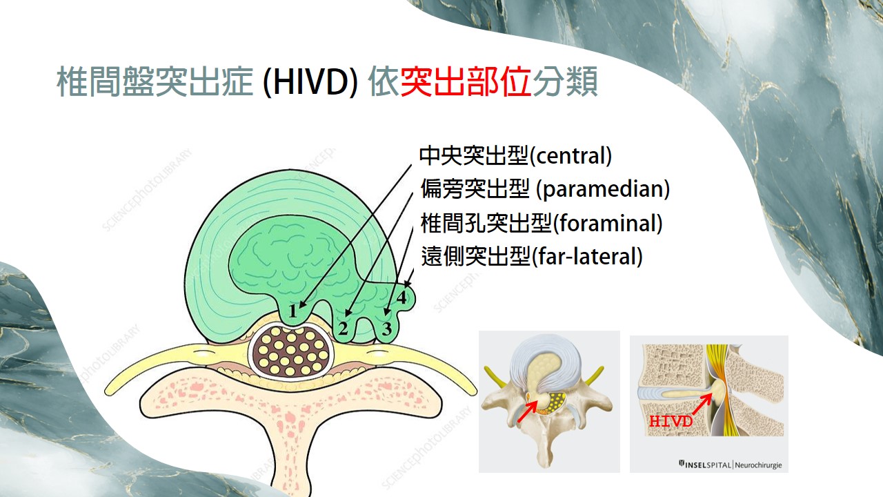 椎間盤突出型態示意圖 投影片17
