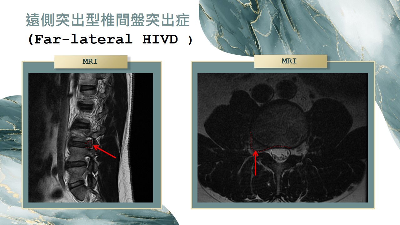 椎間盤突出型態示意圖 投影片18
