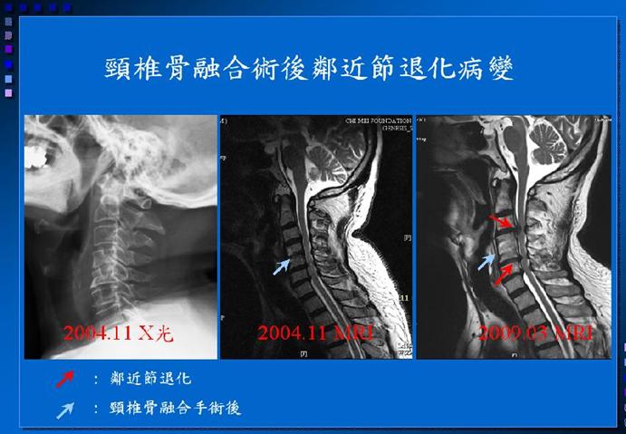 脊椎鄰近節退化影像示意圖 01