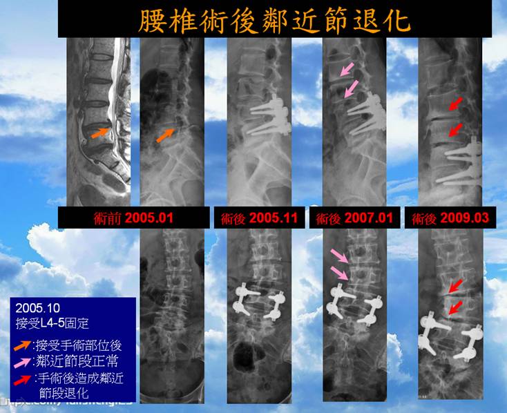 脊椎鄰近節退化影像示意圖 02