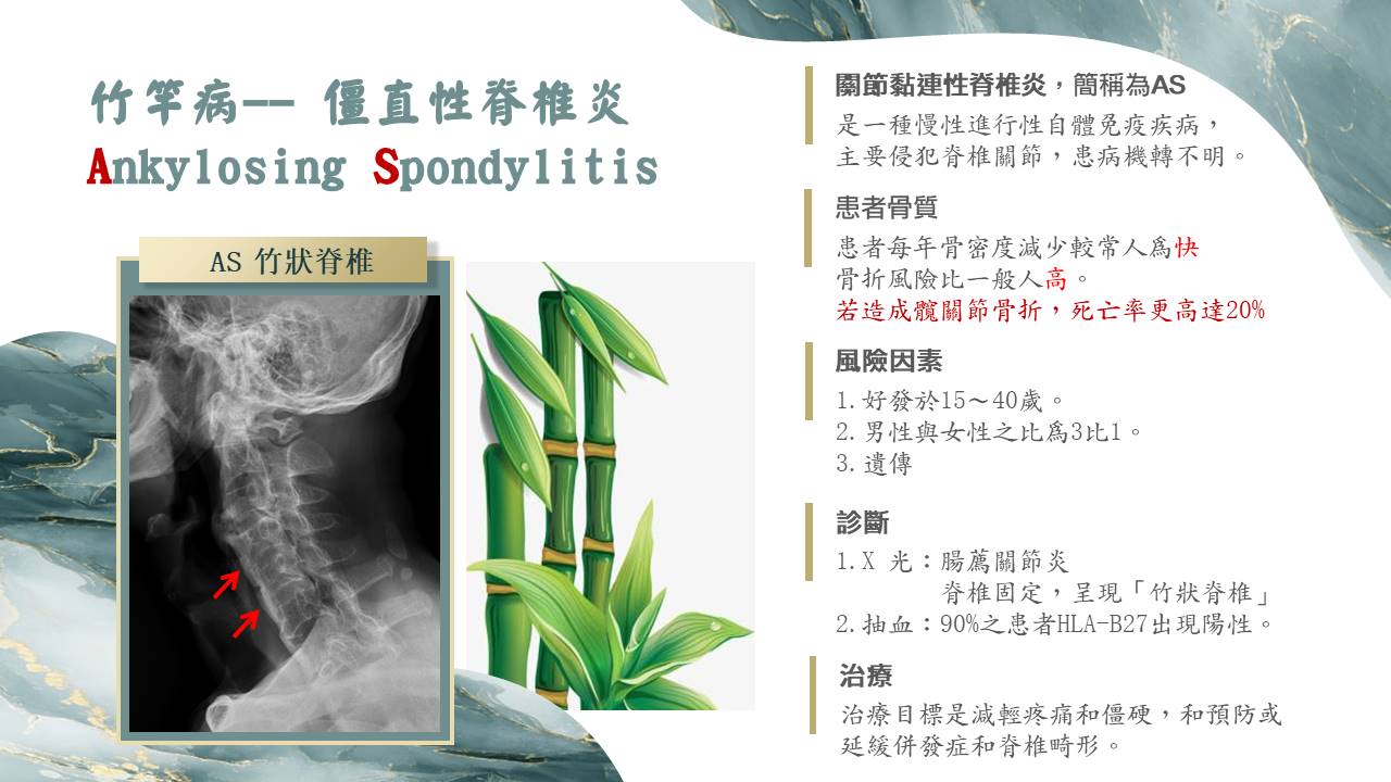 僵直性脊椎炎影像示意圖 01