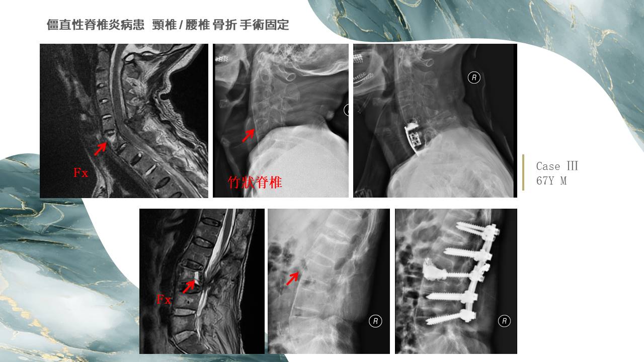 僵直性脊椎炎影像示意圖 03