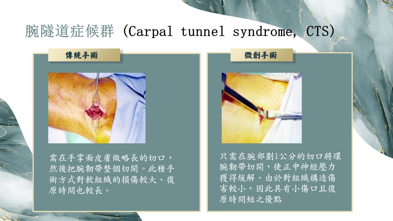 腕隧道症候群治療比較