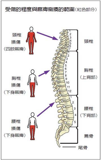脊髓損傷症狀示意圖