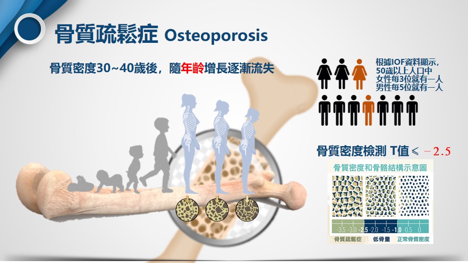 骨質疏鬆示意圖1