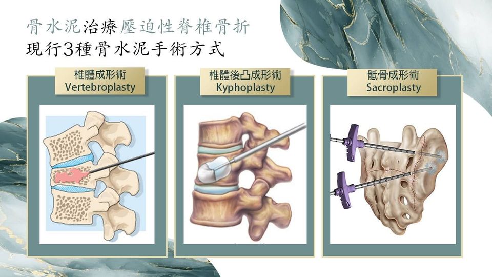 骨水泥注入示意圖