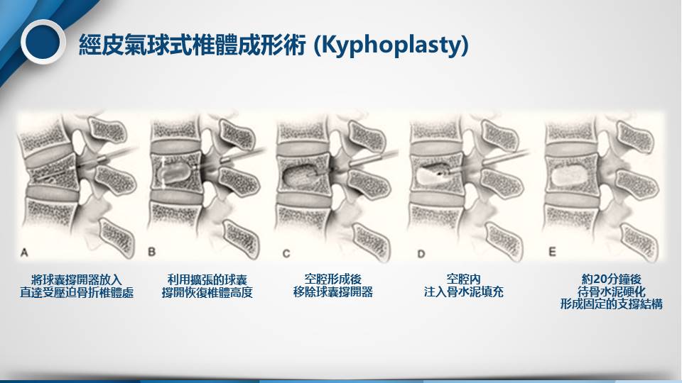 Kyphoplasty示意圖