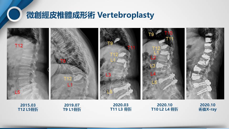 骨質疏鬆影像1