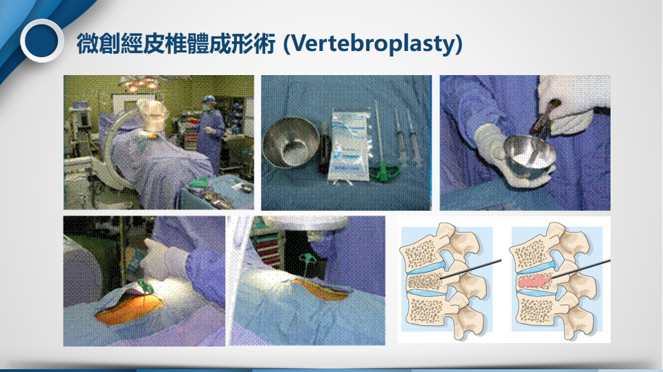 椎體成形術示意圖
