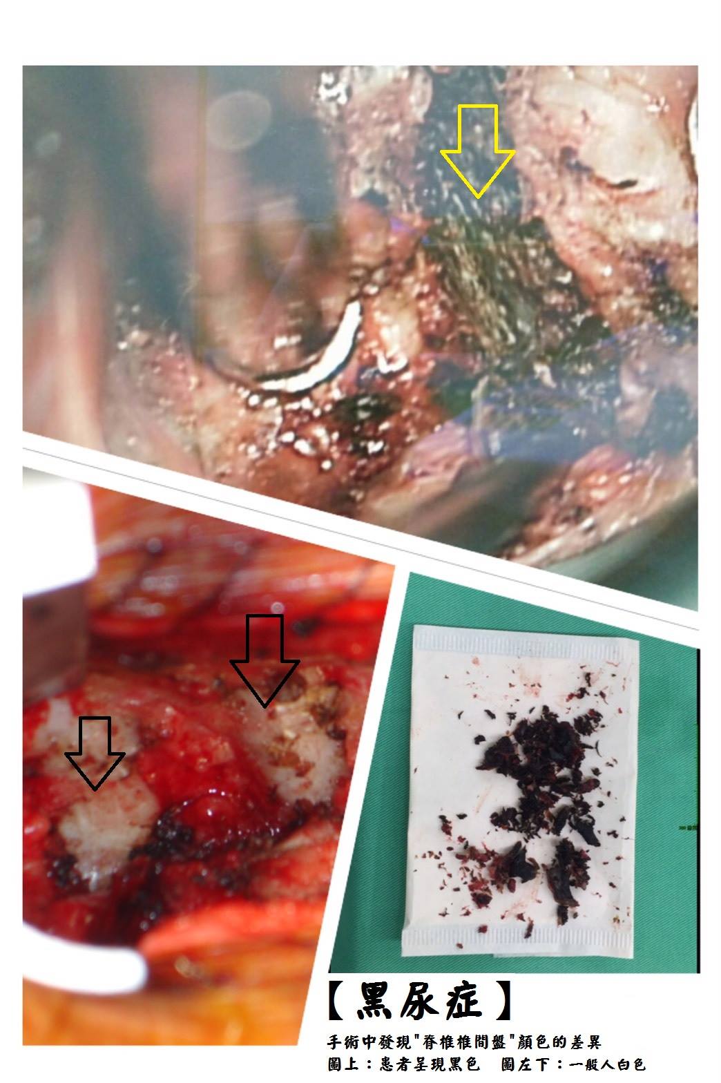 黑尿症示意圖