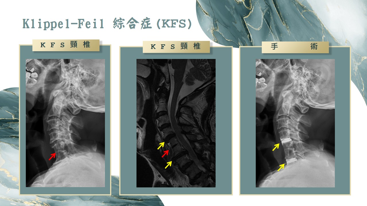 Klippel-Feil 綜合症示意圖