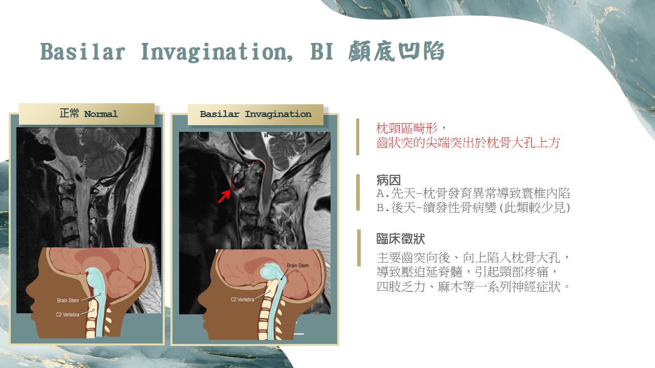 枕頸區畸形影像