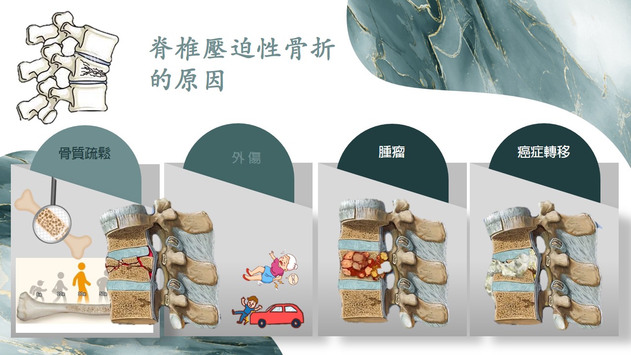 骨折影像