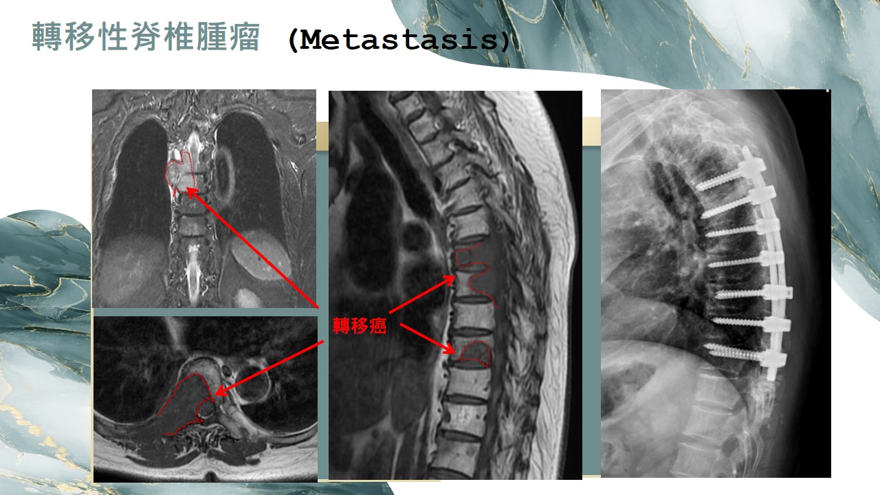 轉移性脊椎腫瘤影像2