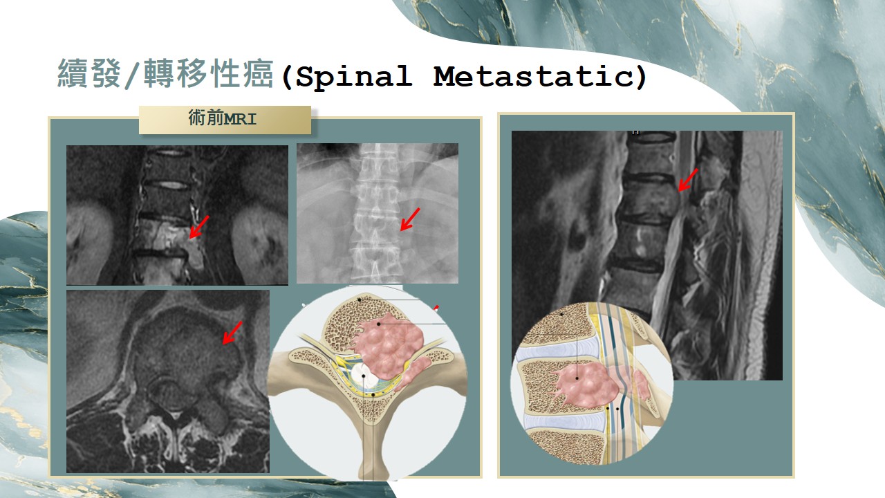 轉移性脊椎腫瘤影像1