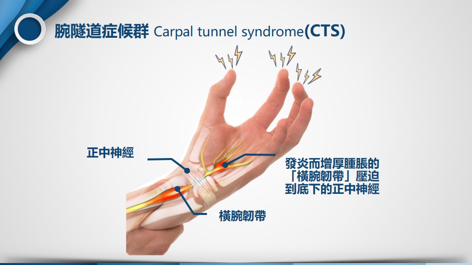 腕隧道症候群示意圖1