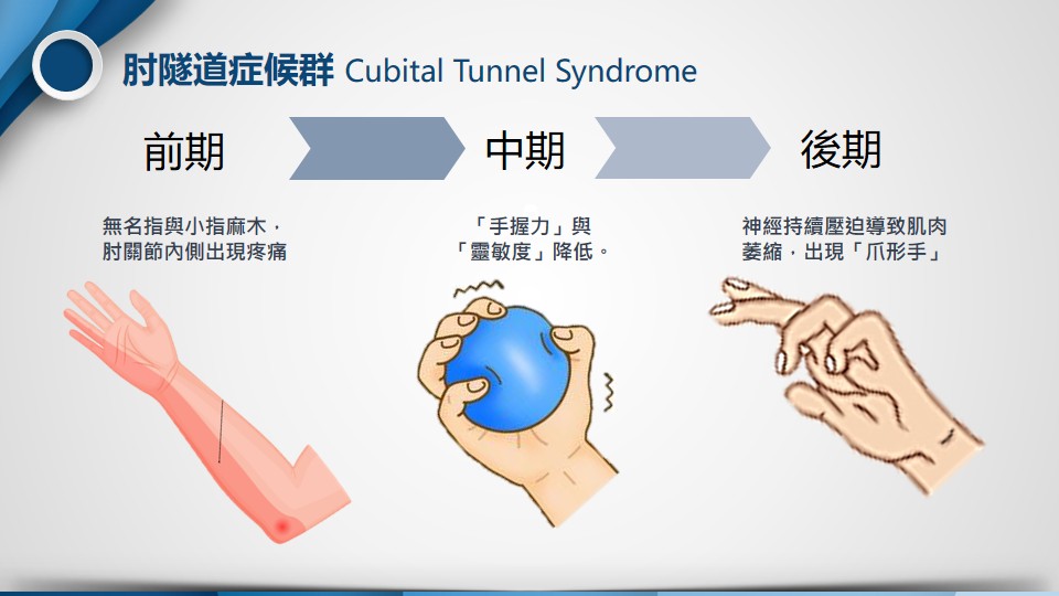 肘隧道症候群影像2