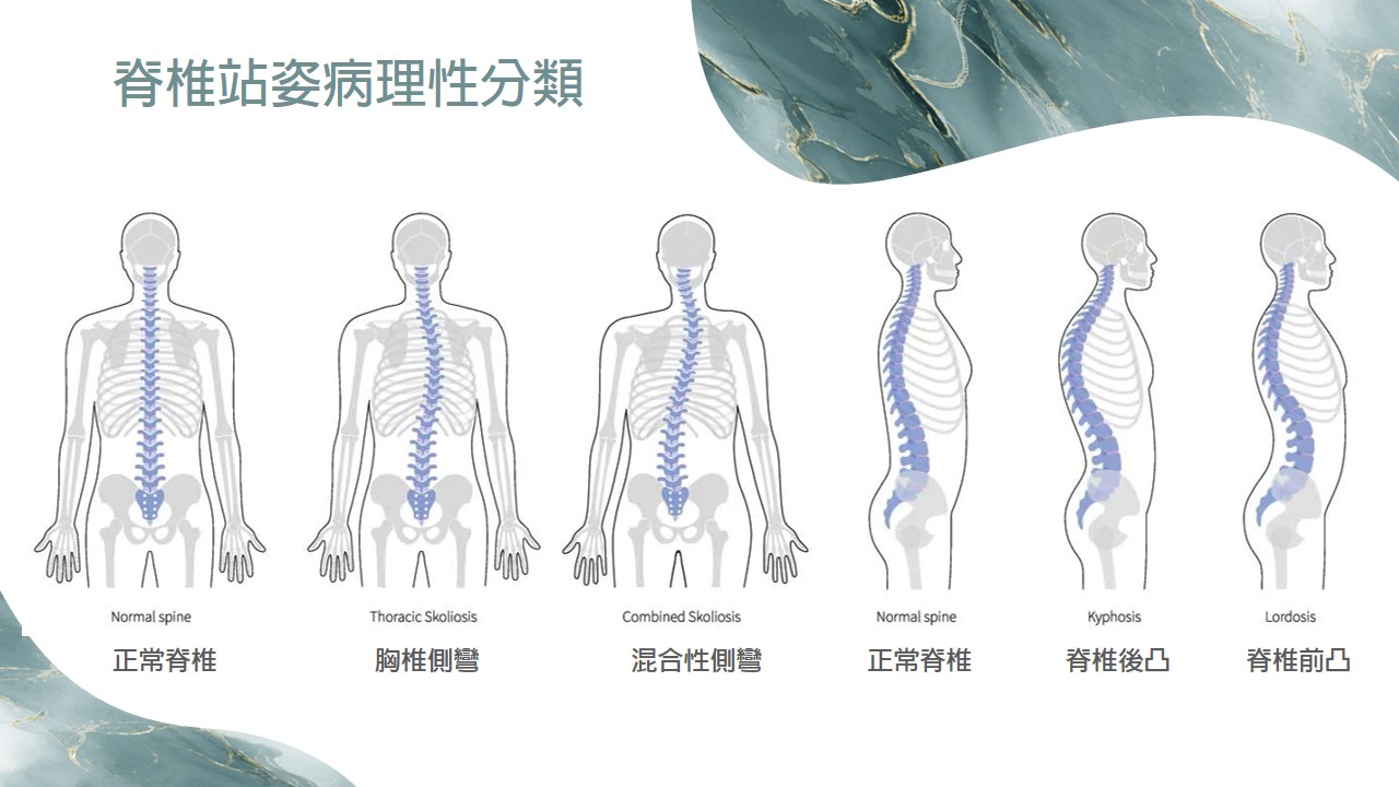脊椎站姿病理性分類示意圖 1