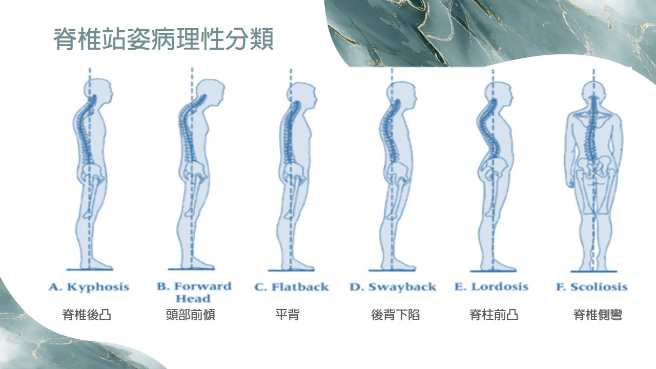 脊椎站姿病理性分類示意圖 2
