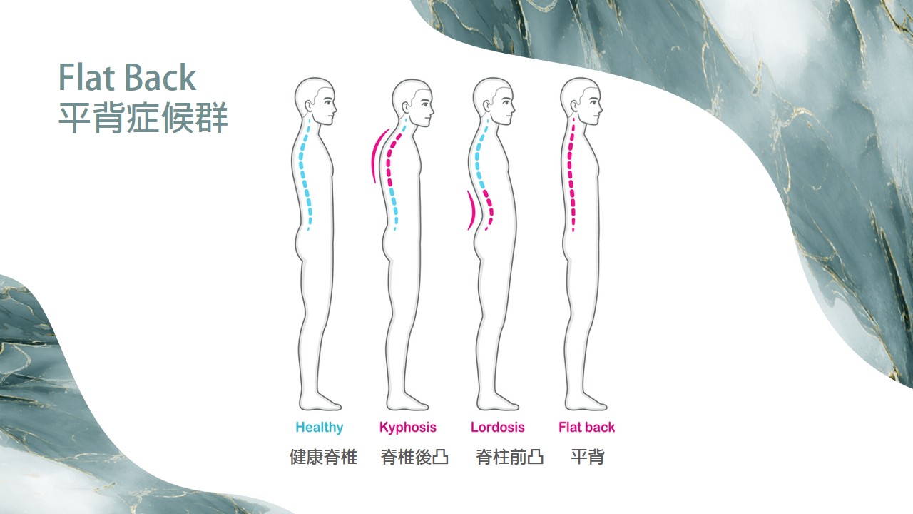 平背症候群示意圖